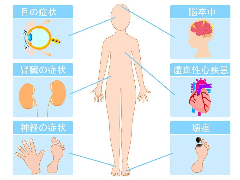 糖尿病は放置するとどうなるの？糖尿病が引き起こす合併症